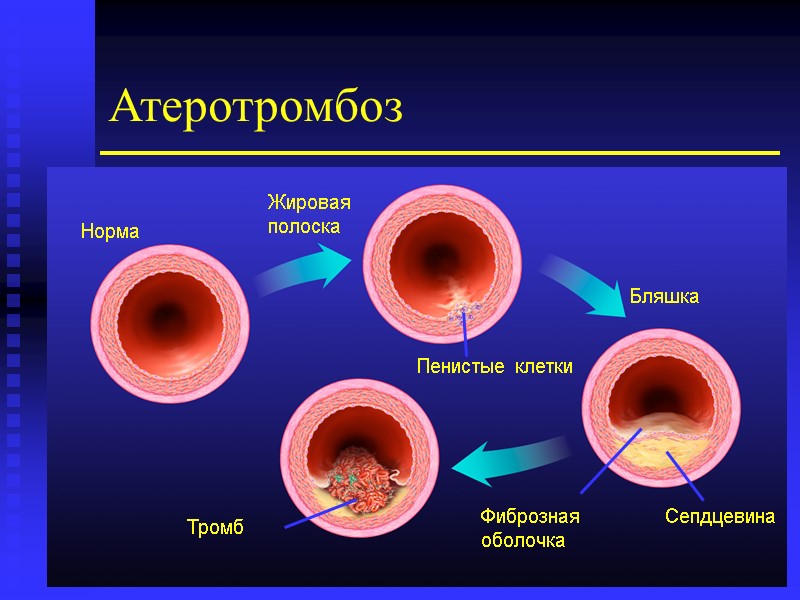 Атеротромбоз Норма Жировая полоска Пенистые клетки Бляшка Сепдцевина Фиброзная оболочка Тромб